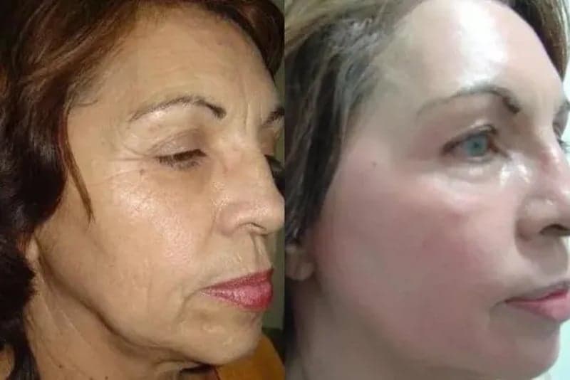 Rejuvenescimento Global