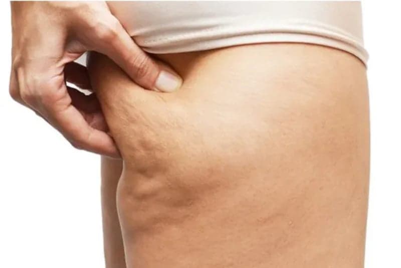 Velashape - Anti Celulite